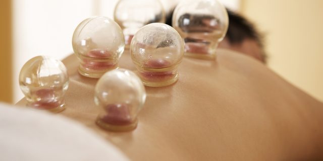 Cupping has evolved and is widely used for pain relief and muscular-skeletal injuries, such as strains, sprains, and inflammation.