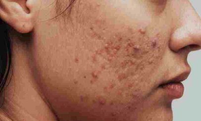 acne-on-face-1326434308-770x533-1-compressed