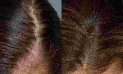 prp+hair+loss+placet+rich+plasma-compressed